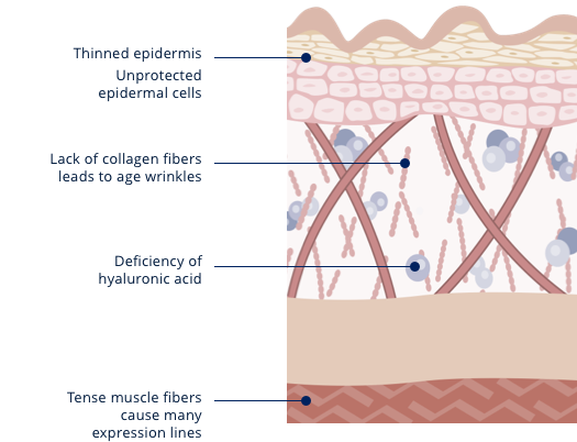 Grafik Haut vor einer Behandlung (en)